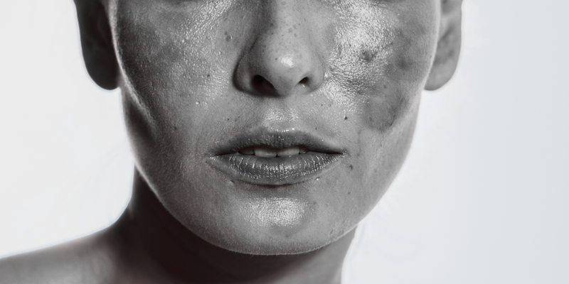 files/Hyperpigmentation_Blog.png