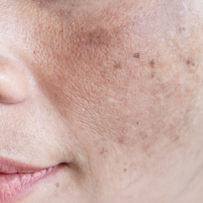 close up a woman's cheek with dark spots