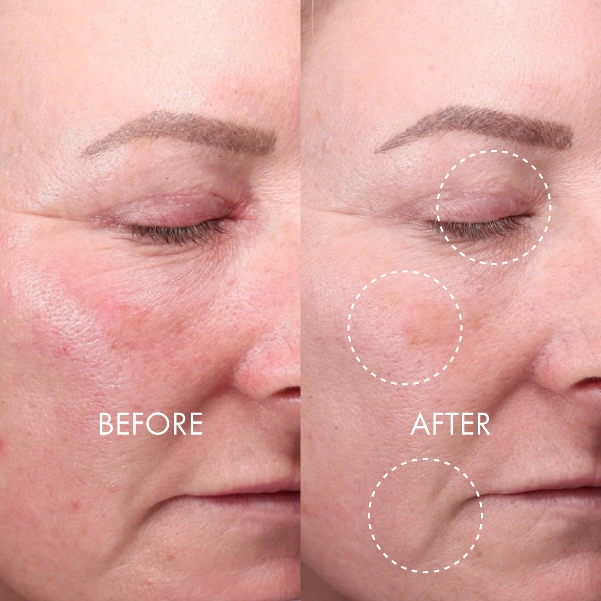 Derma Expert LED Light Treatment