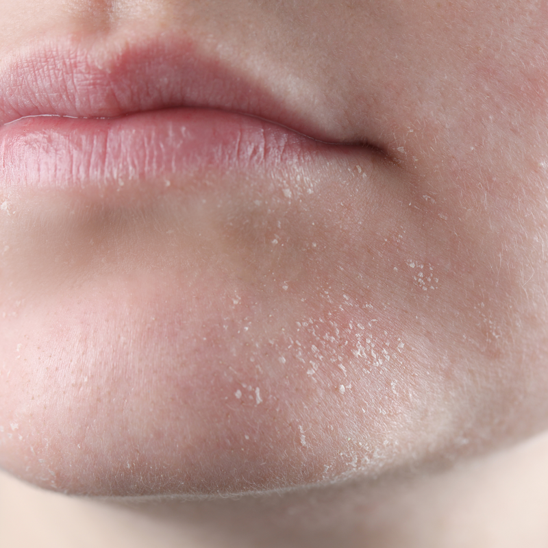 close up image of dry skin on chin