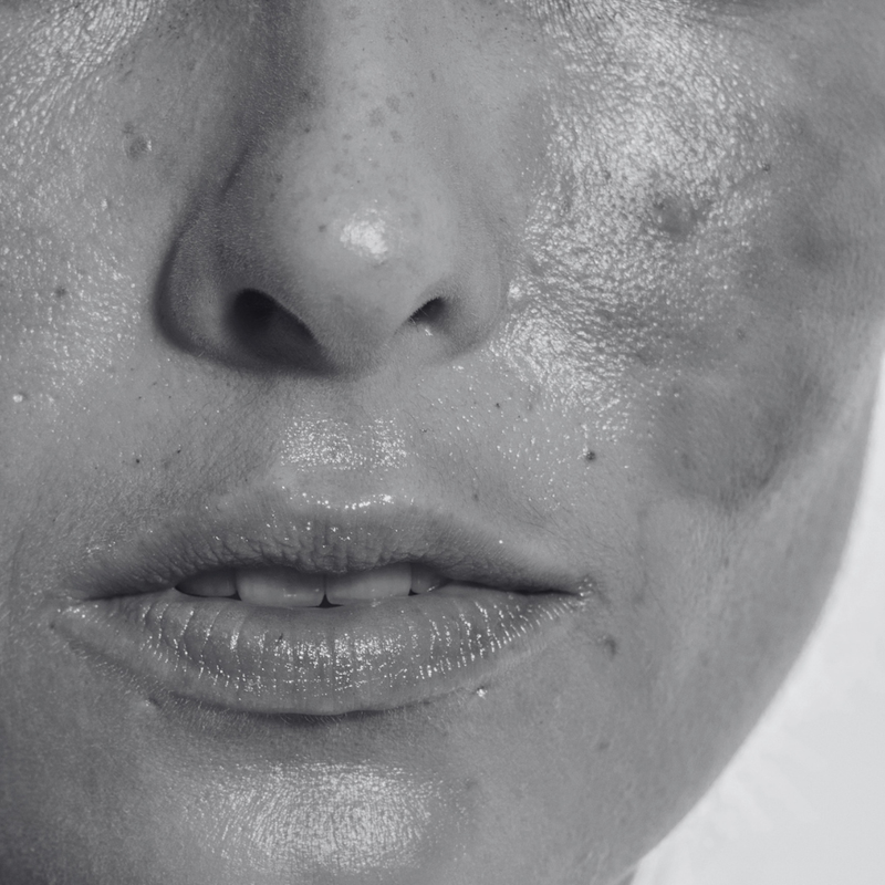 HYPERPIGMENTATION